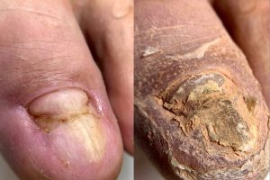 Обработка врастающего или травмированного ногтя