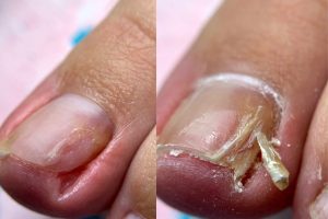 Обработка врастающего или травмированного ногтя