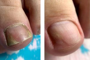 Зачистка онихолизиса или гигиеническая обработка 1 ногтевой пластины